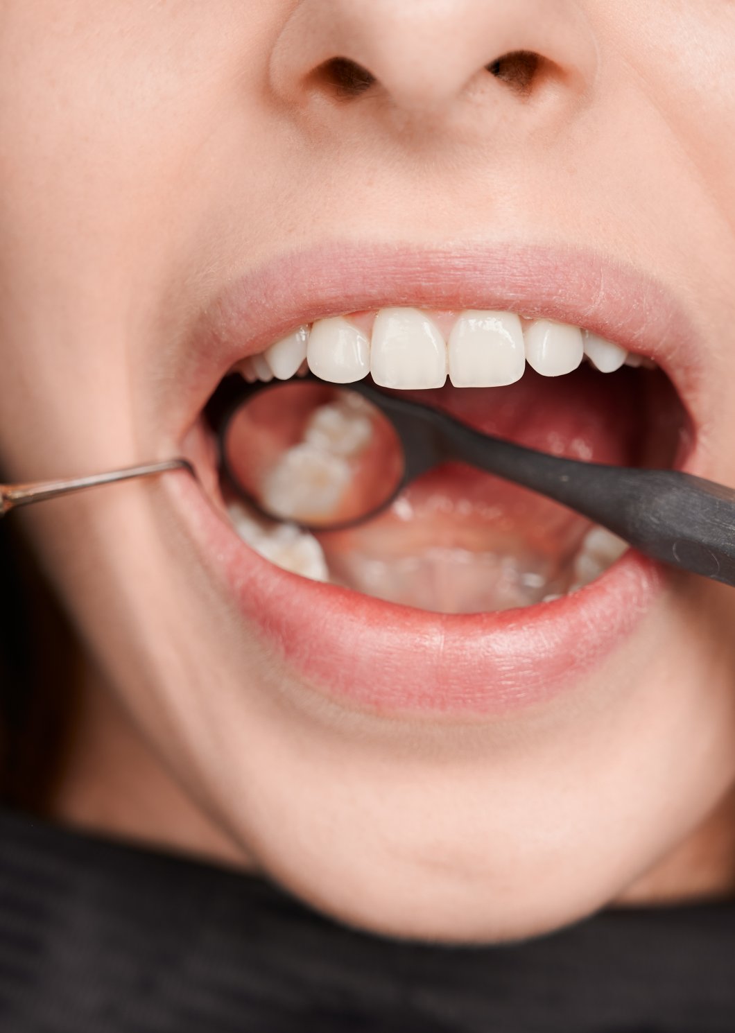 Dantenų uždegimas ir jo pasekmės: gingivitas, periodontitas